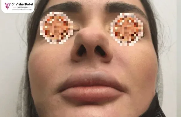 A patient with wide nose in Mumbai – Candiate for Wide nose rhinoplasty A patient with wide nose in Mumbai - Candiate for Wide nose rhinoplasty