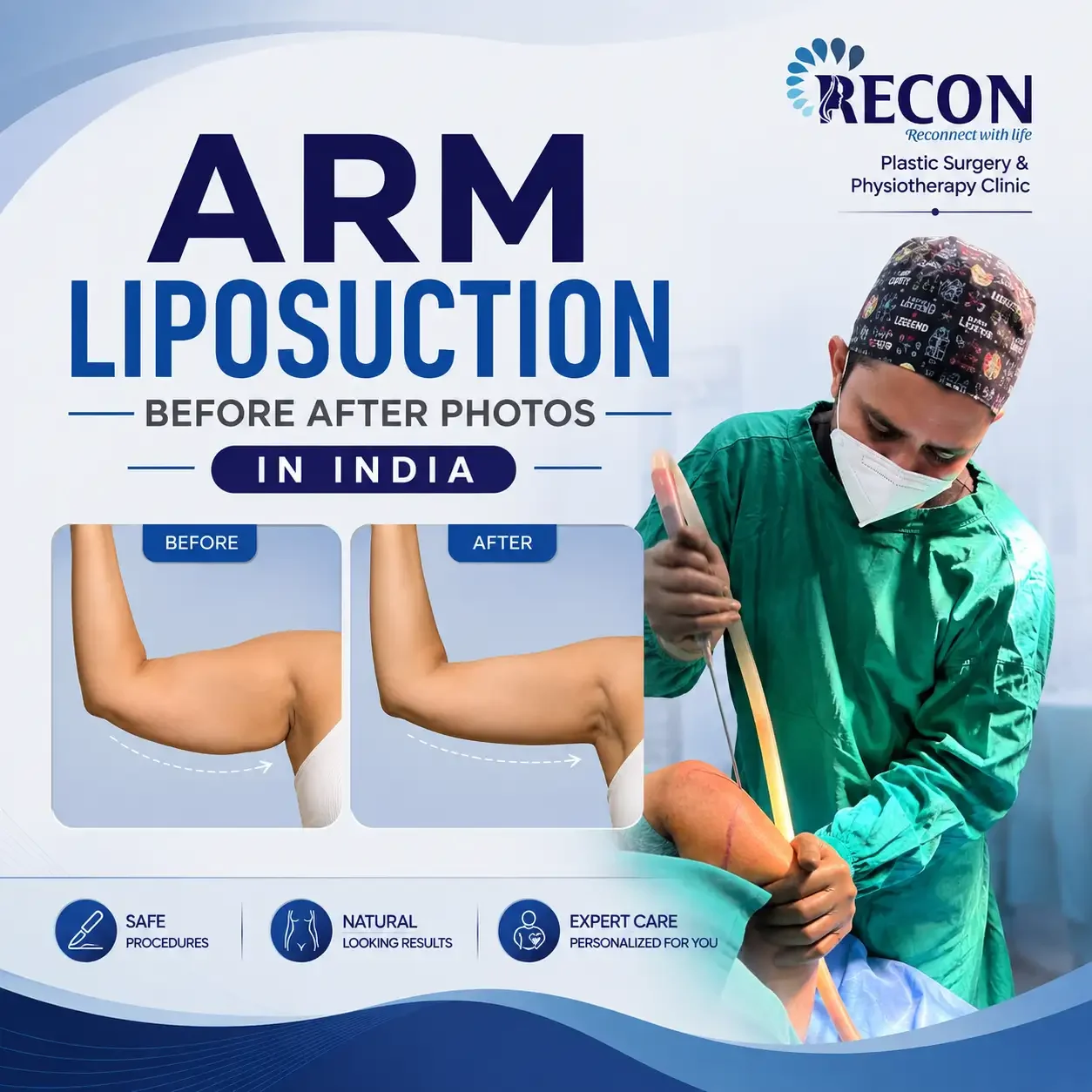 Arm Liposuction Before After Photo in Mumbai India