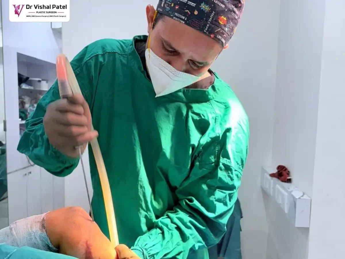 Dr. Vishal Patel holding Liposuction cannula inserted into Arms.
