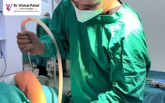 Arm Liposuction in Mumbai by Dr. Vishal Patel Arm Liposuction in Mumbai by Dr. Vishal Patel