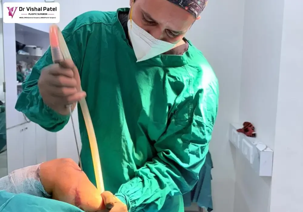 Arm Liposuction in Mumbai by Dr. Vishal Patel