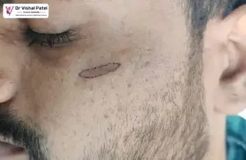 Atrophic Scar Treatment in Mumbai by Dr. Vishal Patel Atrophic Scar Treatment in Mumbai by Dr. Vishal Patel