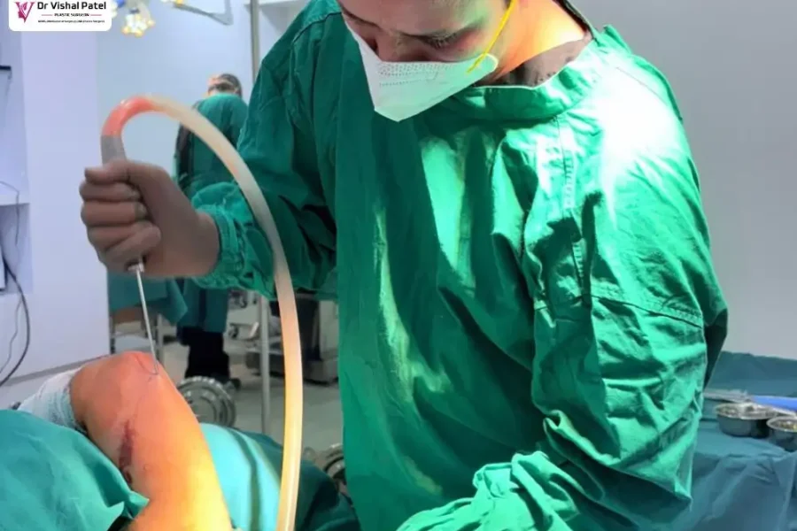 Best Arm Liposuction Surgeon in Mumbai – Dr. Vishal Patel Best Arm Liposuction Surgeon in Mumbai - Dr. Vishal Patel