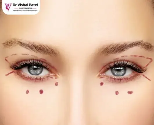 Best Blepharoplasty in Mumbai India - Dr. Vishal Patel