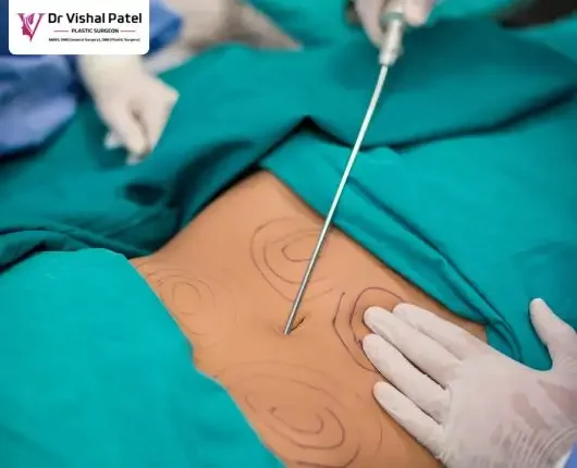 Best Stomach Liposuction in Mumbai by Dr. Vishal Patel Best Stomach Liposuction in Mumbai by Dr. Vishal Patel