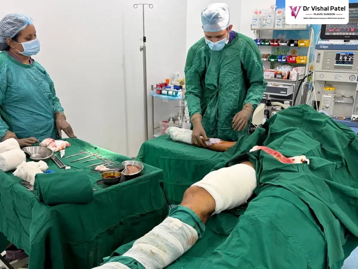 Dr. Vishal Patel harvesting graft from thigh region in a skin grafting surgery.