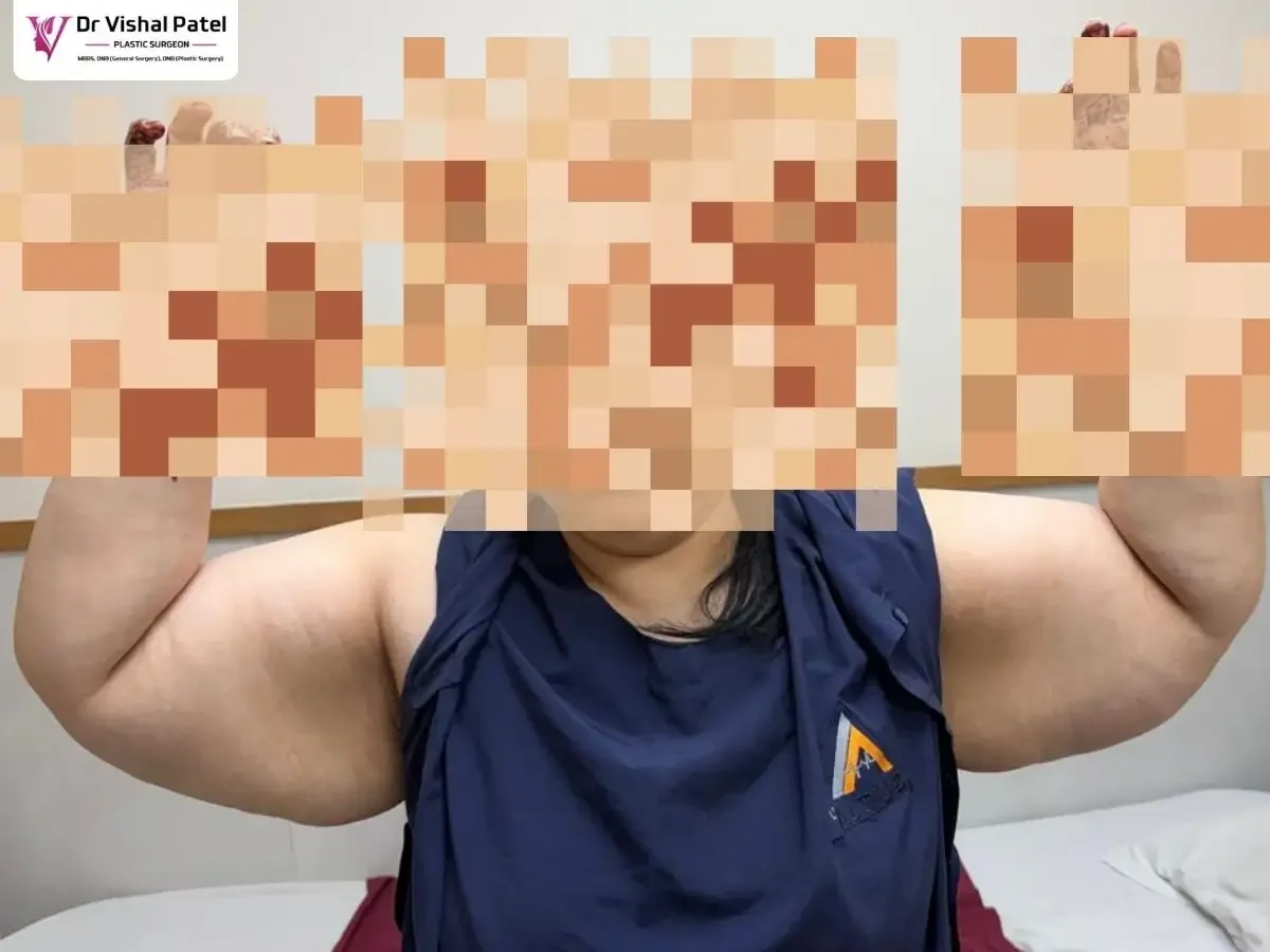 Patient showing her heavy arms with fat accumulated.