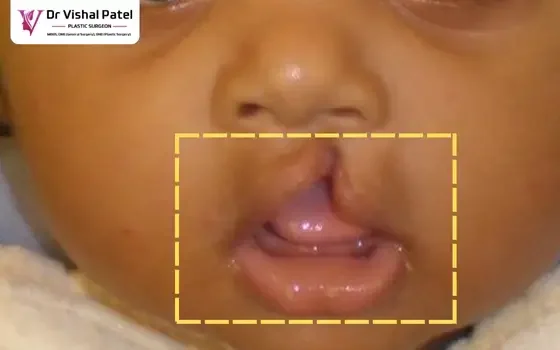 Close up view of Cleft lip of a baby boy in India.