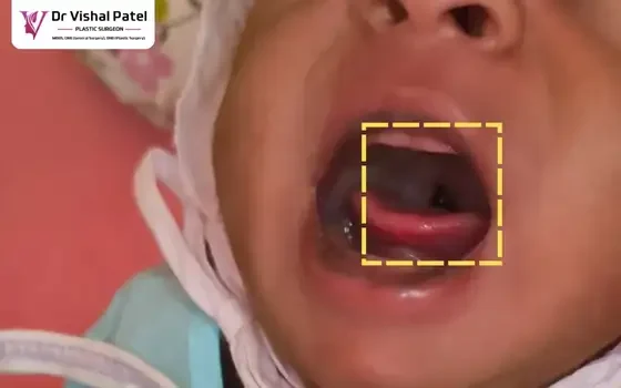 Throat view of boy with cleft palate in Mumbai.