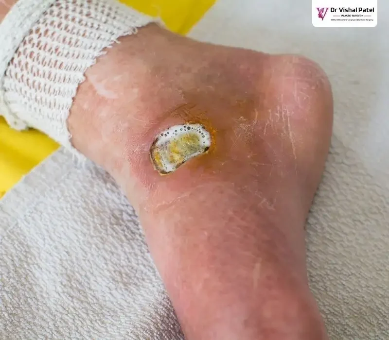 Leg of diabetic patient with stage 3 pressure ulcer.