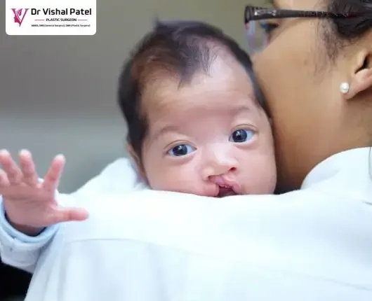 Women holding baby with cleft lip on her shoulder.