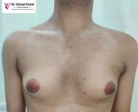 Cost of Grade 3 Gynecomastia Surgery in Mumbai Malad