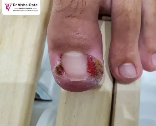 An ingrown toenail with severe infection.