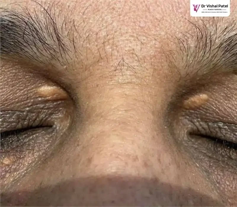 A Xanthoma patient eyelids with yellowish patches.