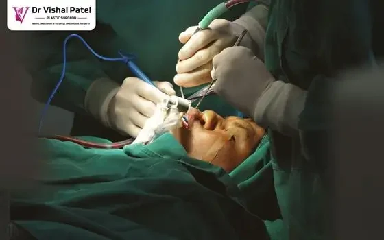 Double Chin Removal with Chin Tuck Surgery in Mumbai by Dr. Vishal Patel