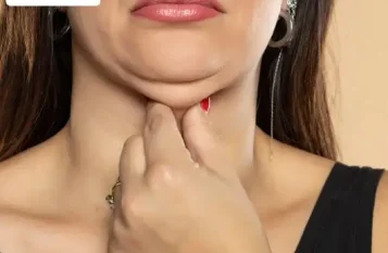 Double chin removal in Mumbai by Dr. Vishal Patel