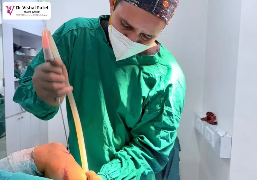 Dr. Vishal Patel performing Arm Liposuction surgery in Mumbai.