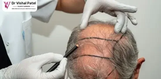 FUE Hair Transplant in Mumbai by Dr Vishal Patel