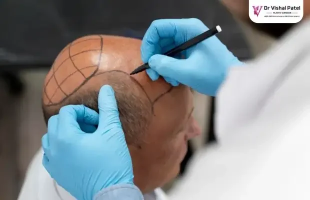 FUE Hair transplant in Mumbai by Dr Vishal Patel