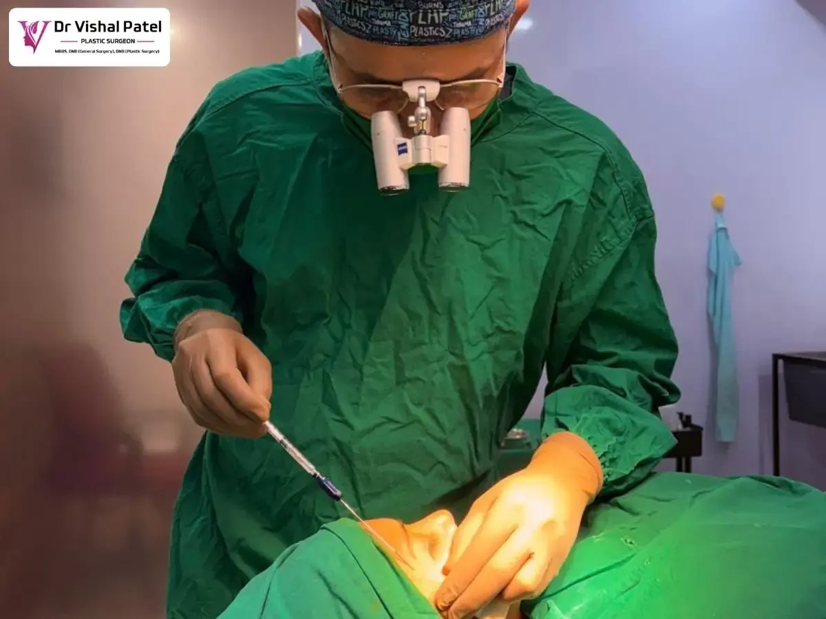Dr. Vishal Patel doing subcision before fat grafting surgery.