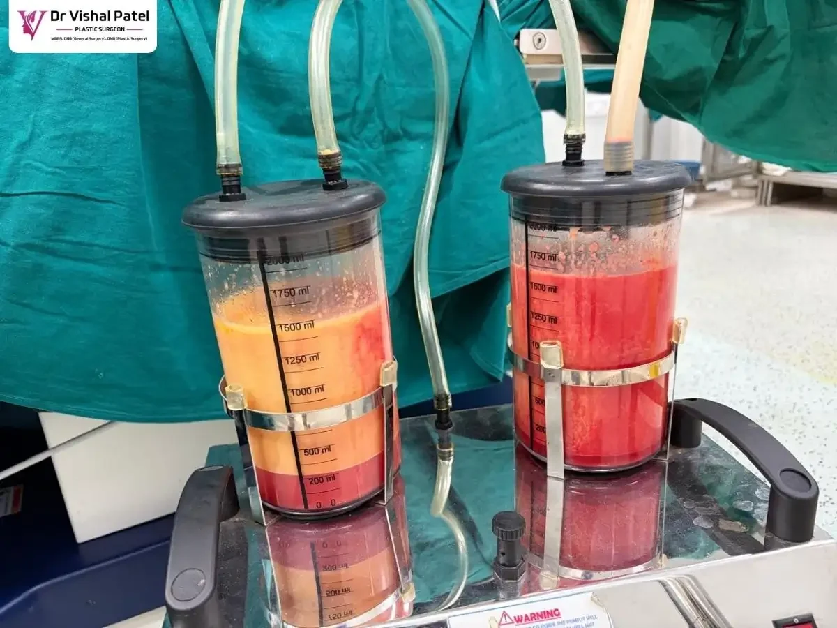 Liquid Fat collected in Jars after Liposuction surgery.