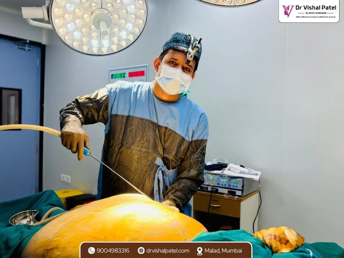 Dr. Vishal Patel doing Fleur De Lis Tummy tuck in Mumbai India