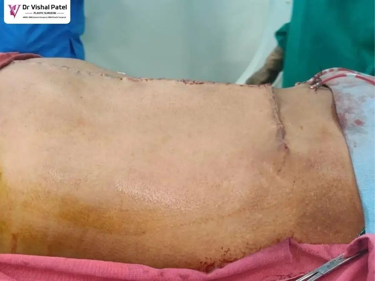 Patient abdomen photo showing drainage pipes for liquid outflow.