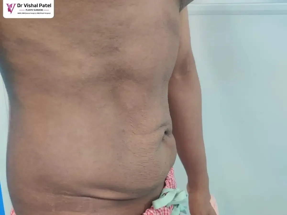 Fleur-de-lis Tummy tuck surgery in Mumbai - Before surgery photo - Side view