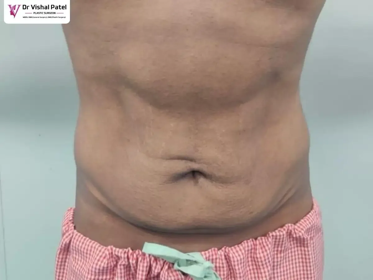 Patient abdomen before surgery showing extra skin with folds.