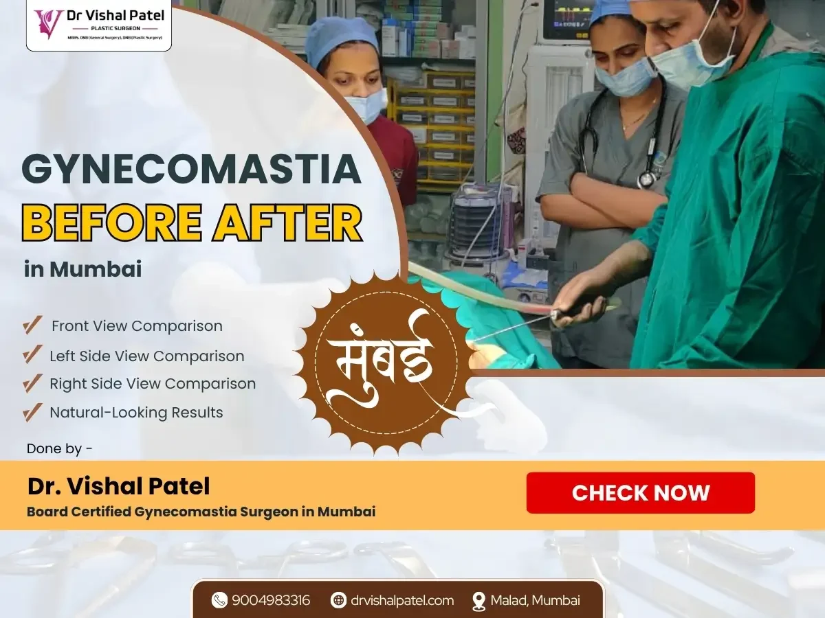 Gynecomastia Before After Photos in Mumbai India by Dr. Vishal Patel