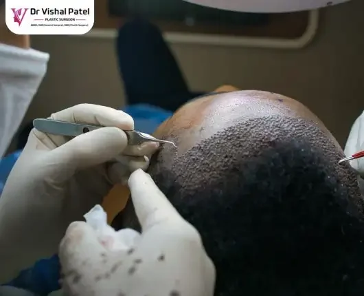 Hair transplant cost in Mumbai - Explained by Dr Vishal Patel