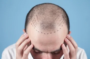 Hair transplant in Mumbai