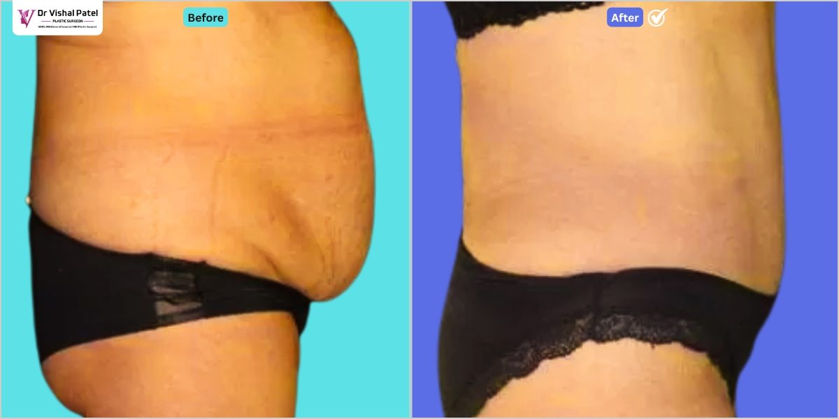 Indian Female in Mumbai Tummy tuck Abdominoplasty Before After