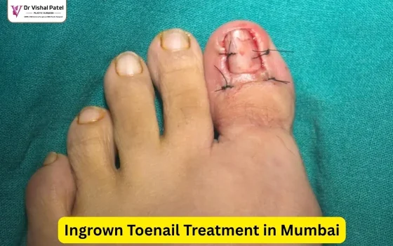 Patient's toenail with stitches after surgery by Dr. Vishal Patel.