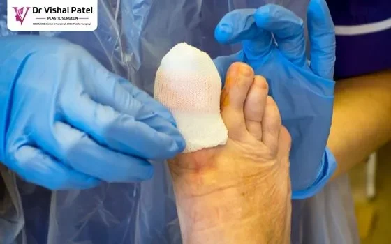 An ingrown toenail after surgery wrapped in dressing tape.