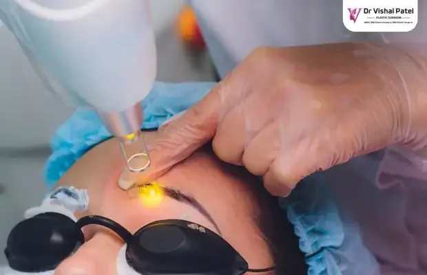 Laser blepharoplasty cost in Mumbai - Dr Vishal Patel