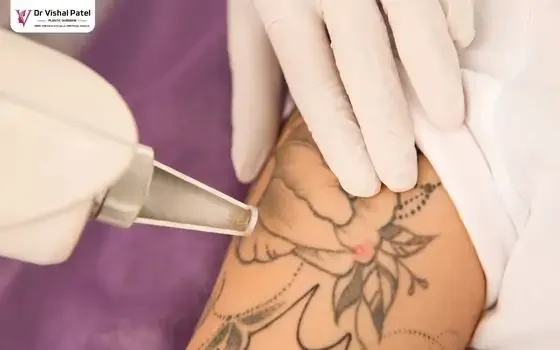 Tattoo being removed with Laser machine.