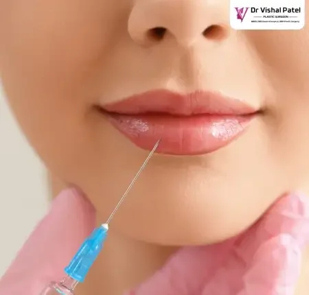 Lip fillers cost in India – by Dr Vishal Patel in Mumbai Lip fillers cost in India - by Dr Vishal Patel in Mumbai