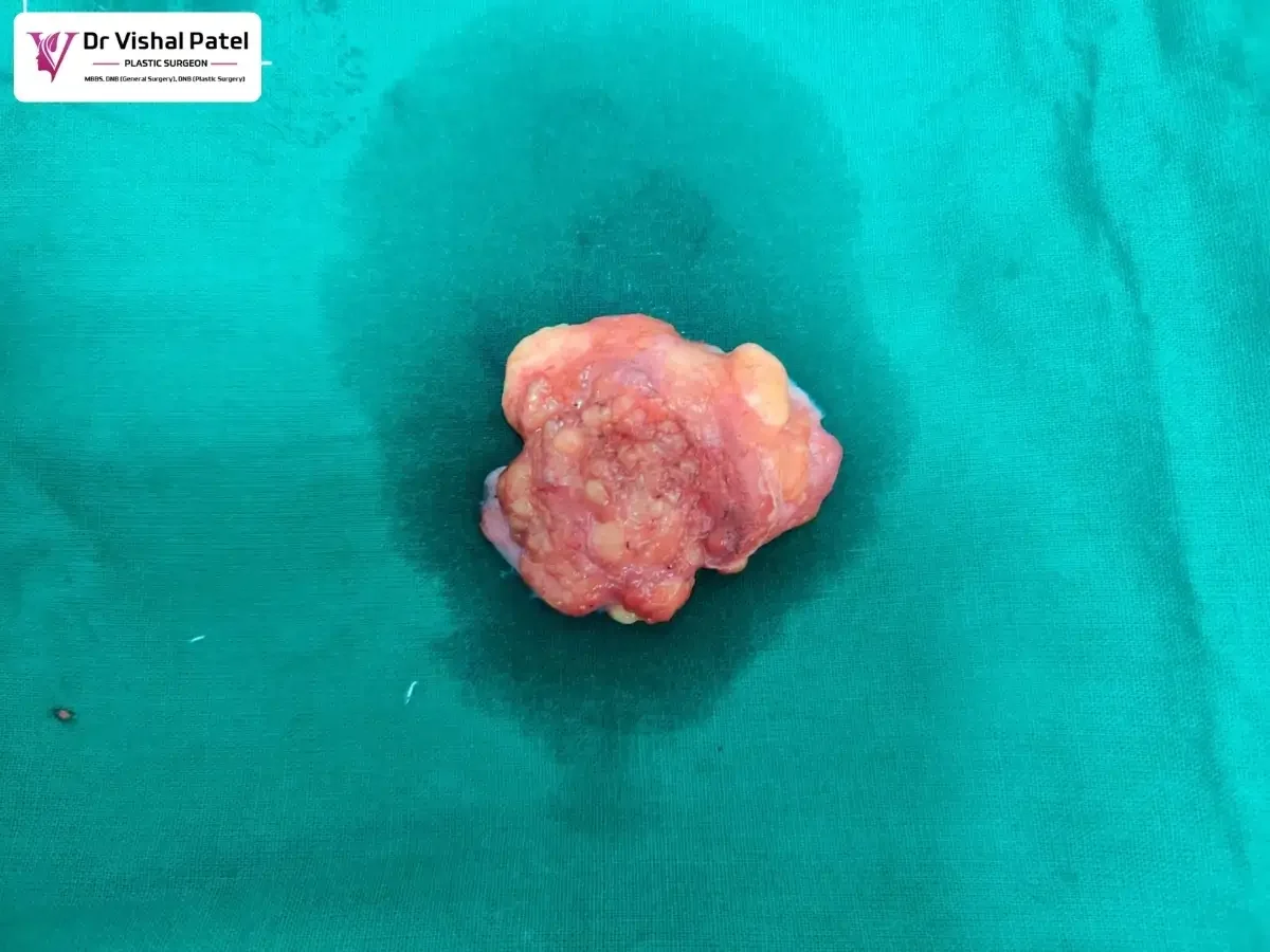 1 Lipoma fat tissue after removal from body.