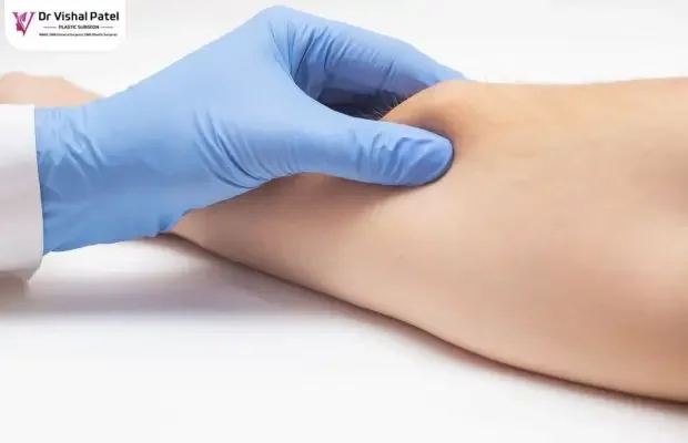 Lipoma removal cost in Mumbai - by Dr Vishal Patel