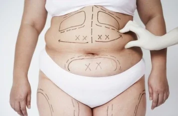 Liposuction in Mumbai - Dr Vishal Patel