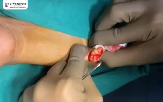 Lipoma tissue coming out after pressing on forearm.
