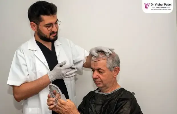 Marking for Hair transplant surgery in Mumbai