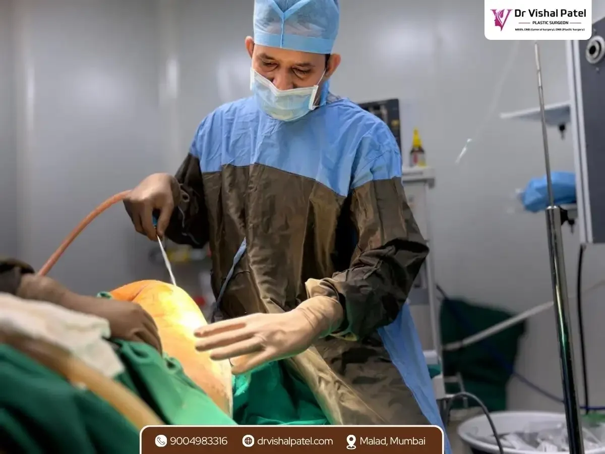 Dr. Vishal Patel doing Liposuction plastic surgery.