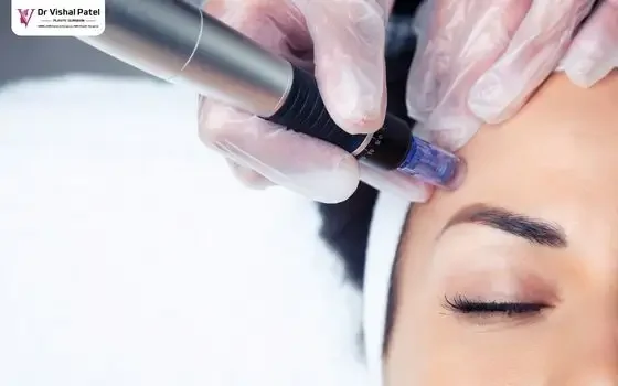 Microneedling RF Treatment on face.