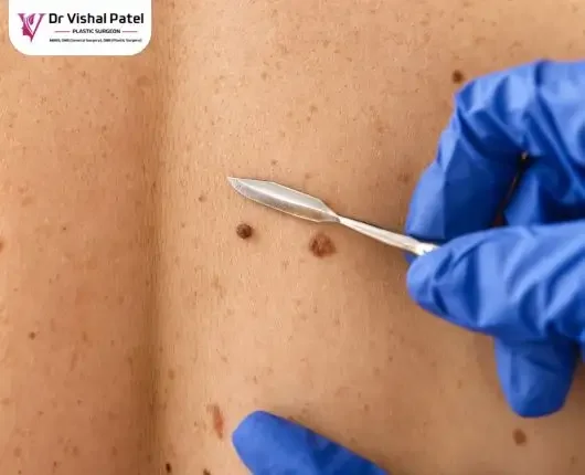 Mole Removal Surgery in Mumbai