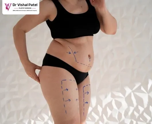 Mommy makeover cost in Mumbai India – Dr. Vishal Patel Explains Mommy makeover cost in Mumbai India - Dr. Vishal Patel Explains