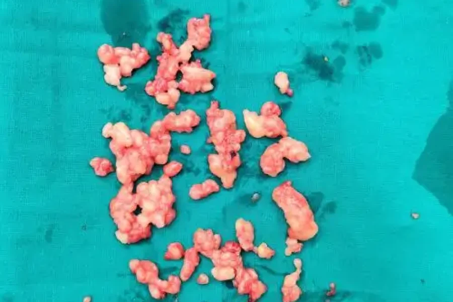 Multiple Lipoma Removed from Body by Dr. Vishal Patel in Mumbai