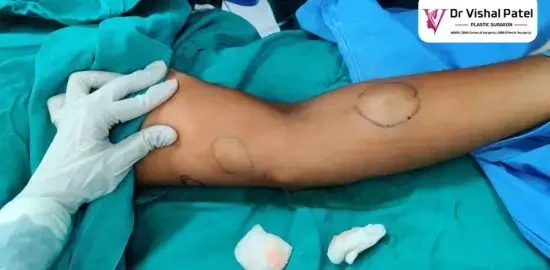 Multiple lipoma on hand – Surgery by Dr. Vishal Patel in Mumbai Multiple lipoma on hand - Surgery by Dr. Vishal Patel in Mumbai