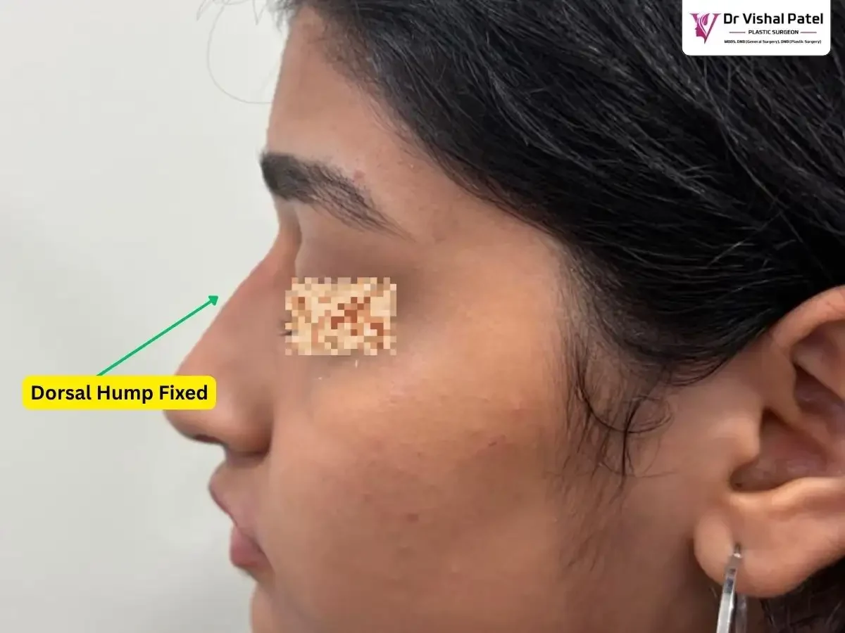 Non surgical rhinoplasty after photo in Mumbai